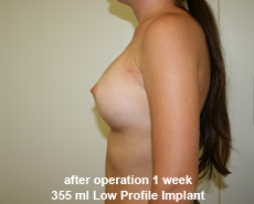 plastic-surgery-breast-augmentation